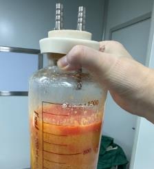 沙河水动力吸脂手术要做多久？